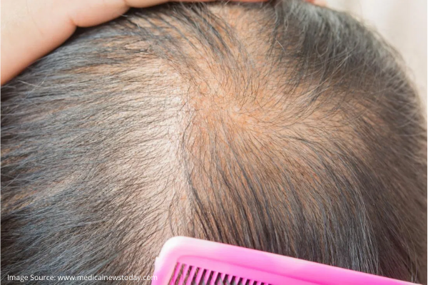 MANAGING HAIR LOSS WITH HAIR TRANSPLANT