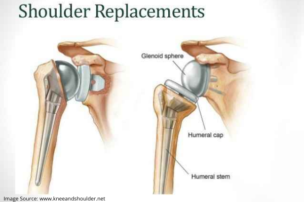 shoulder replacement surgery