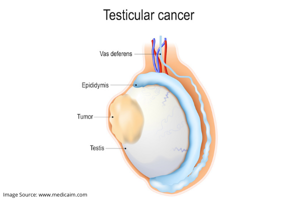 SIGNS OF TESTICULAR CANCER