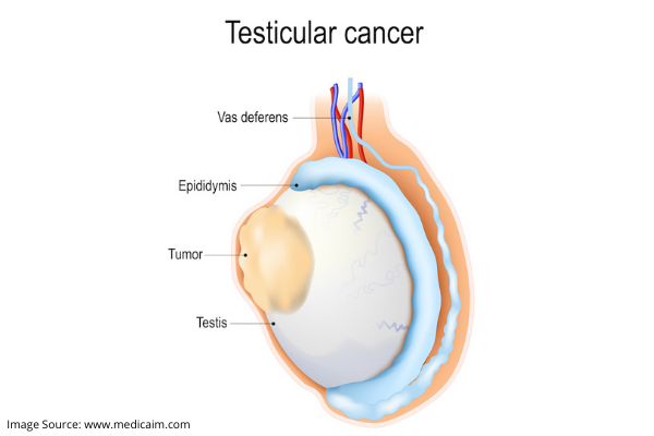 signs of testicular cancer