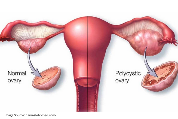 polycystic ovarian disease
