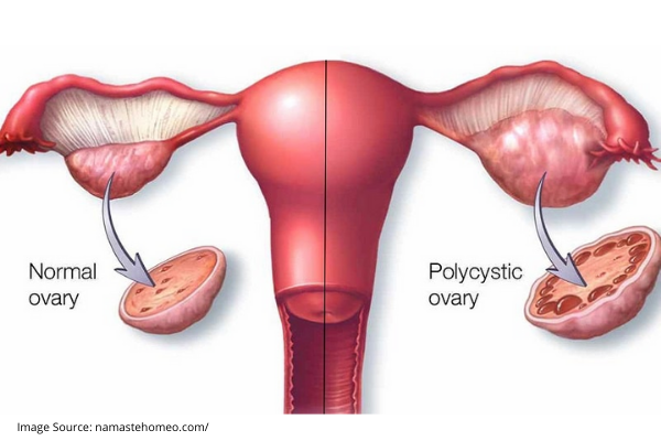 POLYCYSTIC OVARY DISEASE