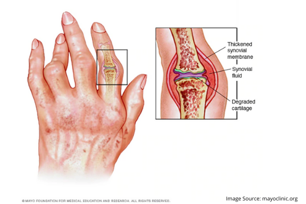 UNDERSTANDING RHEUMATOID ARTHRITIS