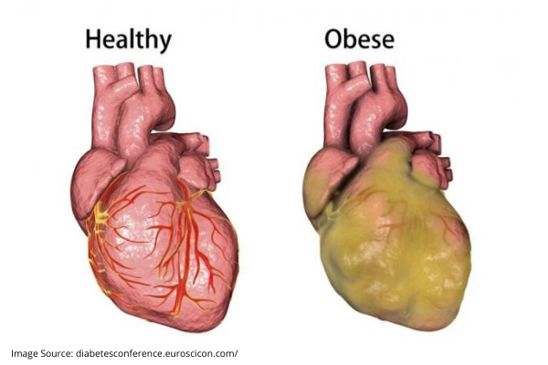 IS HEART DISEASE RELATED TO OBESITY?