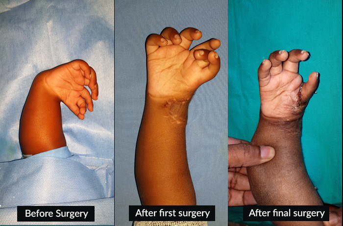 MIRROR HAND, A RARE CONGENITAL ANOMALY OF HAND, GETS CORRECTED IN TWO MAJOR SURGICAL STEPS AT KIMS HOSPITAL.
