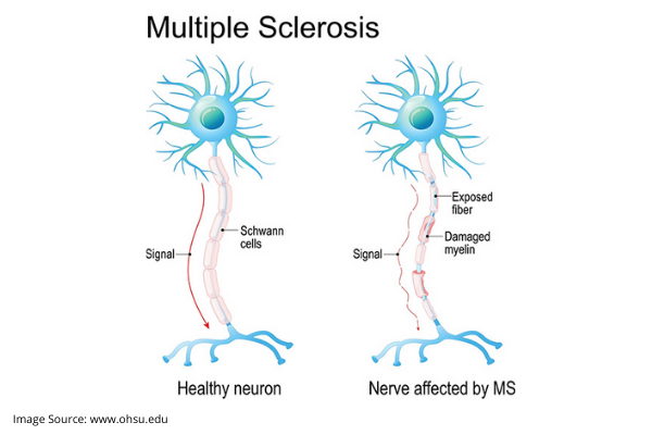 Treatment Options for Multiple Sclerosis