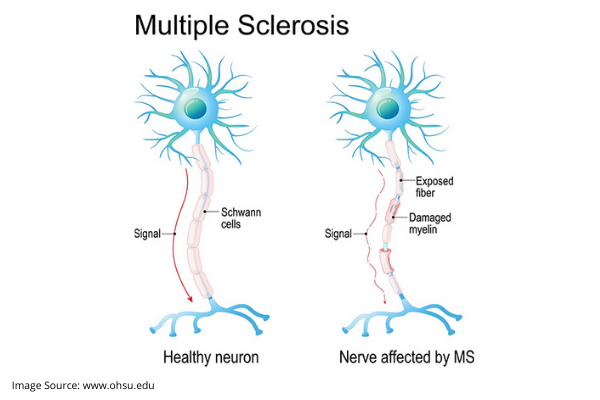 multiple sclerosis treatment