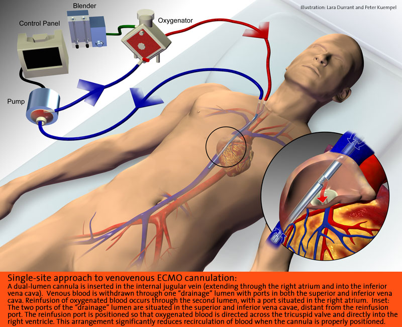 EXTRACORPOREAL MEMBRANE OXYGENATION – ECMO