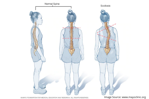 Treatment Options for Scoliosis
