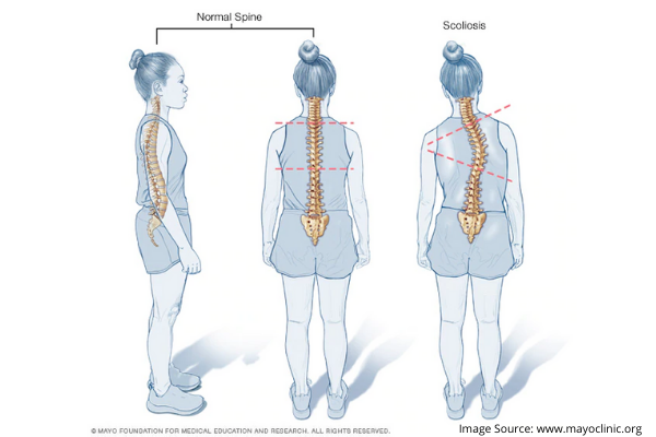 scoliosis treatment options